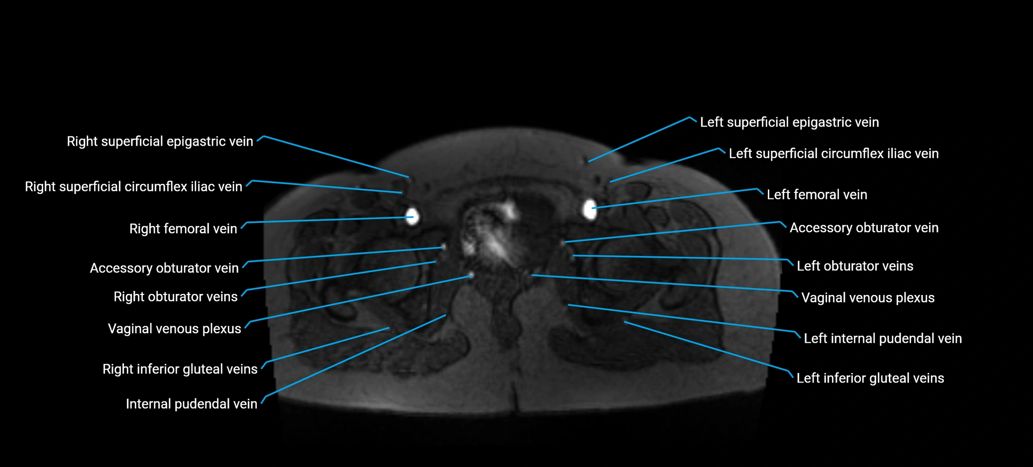 MRV abdomen pelvis & lower limb axial cross sectional anatomy labelled MRI image 185 (1).webp